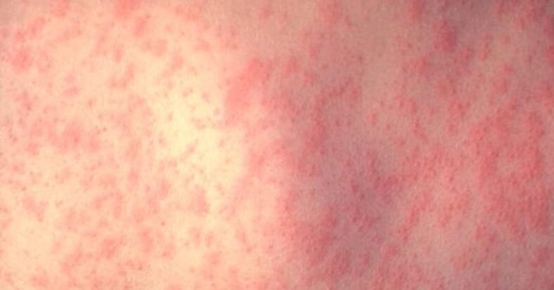 Measles case confirmed in Passaic County, New Jersey, health officials say