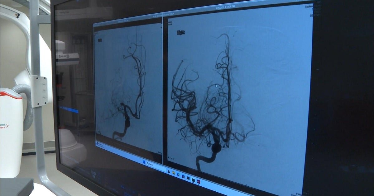 Stroke survivors in Northern Colorado have higher chance of recovery thanks to procedure offered by UCHealth
