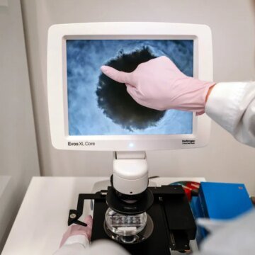 Colorectal Cancer: Facts You Should Know