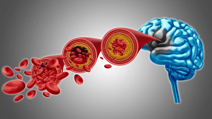 brain-blood-flow-decline-vascular-dementia.webp.webp Scientists found a way to restore brain blood flow in dementia