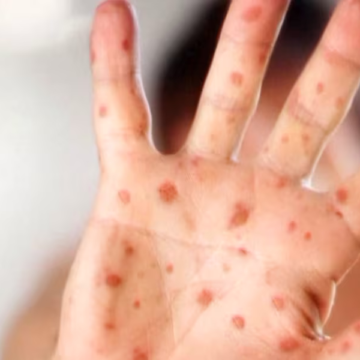 Health officials warn of measles exposure at 3 South Carolina locations