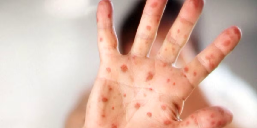 Health officials warn of measles exposure at 3 South Carolina locations