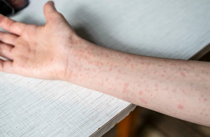 Possible measles exposure at Montgomery County dealership, Wawa – NBC10 Philadelphia