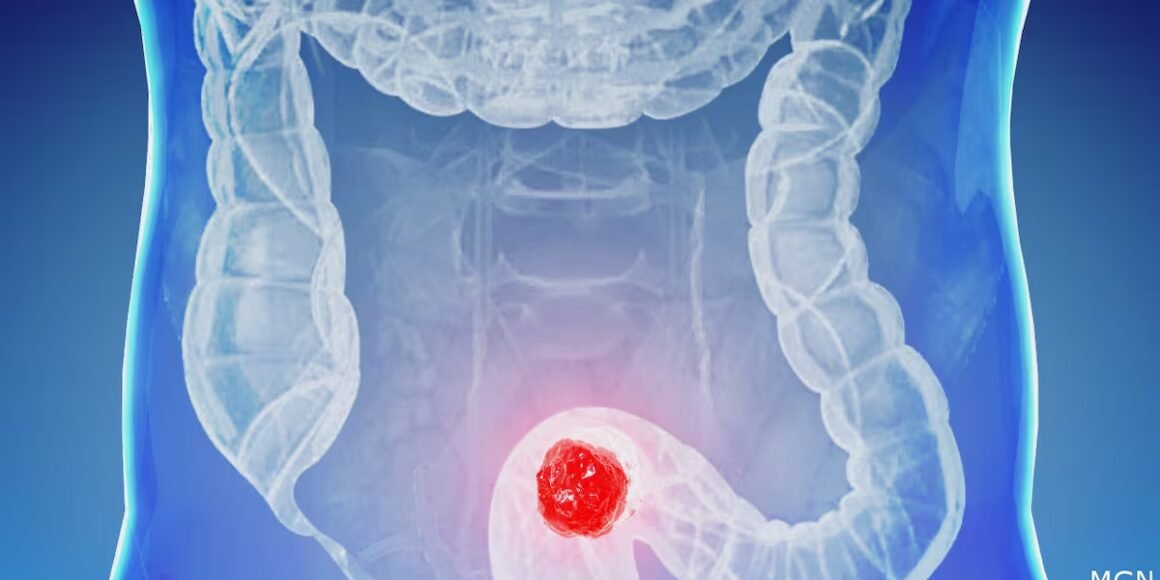 Doctors see increase in colorectal cancer in young people
