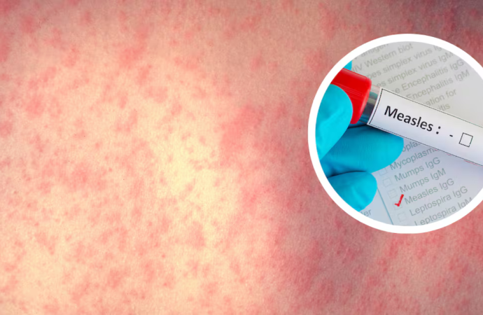 Massachusetts health officials announce confirmed measles cases in child, adult – Boston 25 News