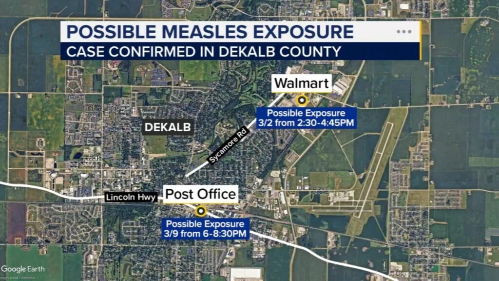 Measles case confirmed in DeKalb County, officials warn of possible exposure at Walmart and US Post Office