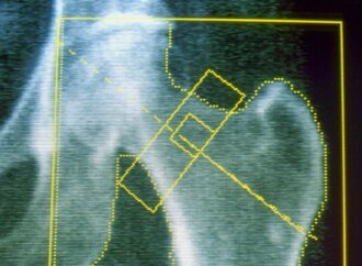 GLP-1s may increase risk of osteoporosis and gout, new research finds