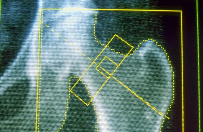 GLP-1s may increase risk of osteoporosis and gout, new research finds