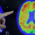 At-home test could spot Alzheimer’s risk early – Exeter research