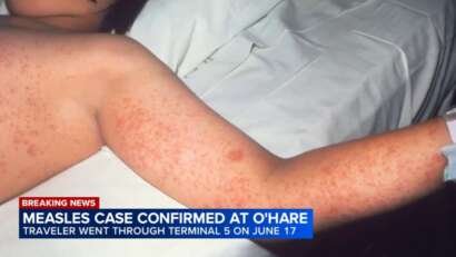 19366197 062326 wls ohare measles case 6pvo vid.jpg