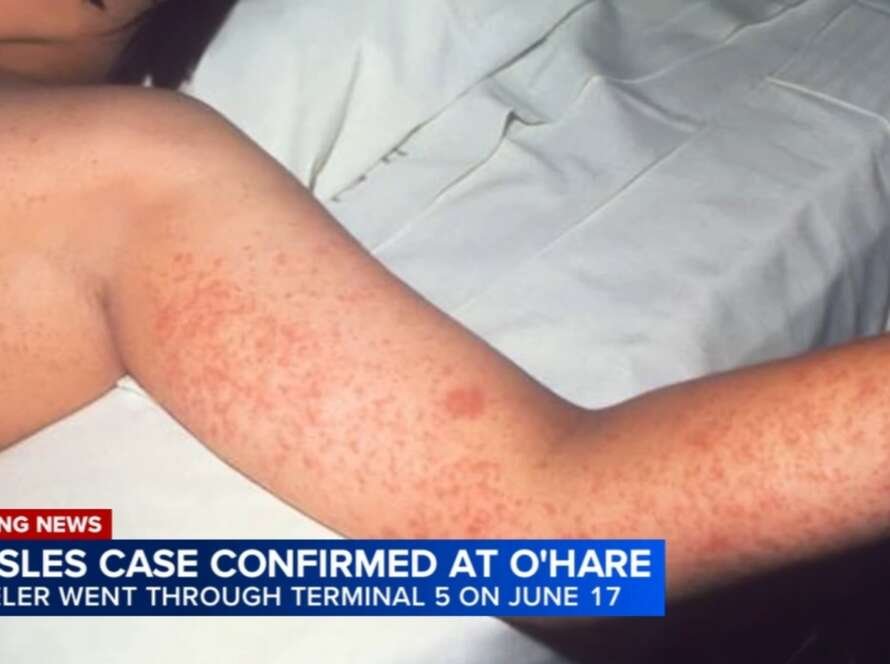 19366197 062326 wls ohare measles case 6pvo vid.jpg