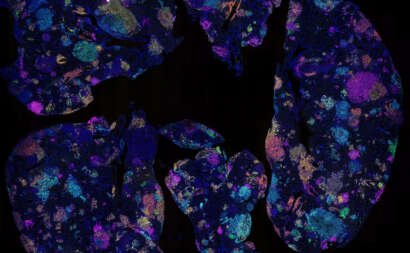 Lung Cancer Lung Tumours web.jpg