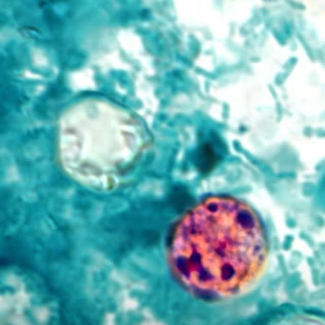 HEALTH NEWS: Up to 200 cases of cyclosporiasis have been reported in New Jersey amid ...